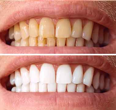 orthosquare teeth whitening