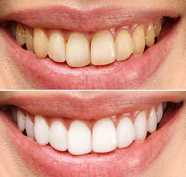 orthosquare teeth whitening