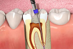 orthosquare root canal
