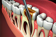 orthosquare root canal