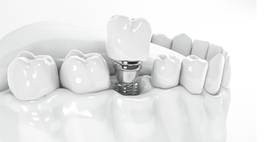 orthosquare complete denture