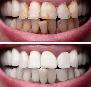 orthosquare teeth braces