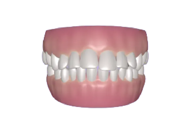 Invisible and Clear Aligners Treatment for Teeth